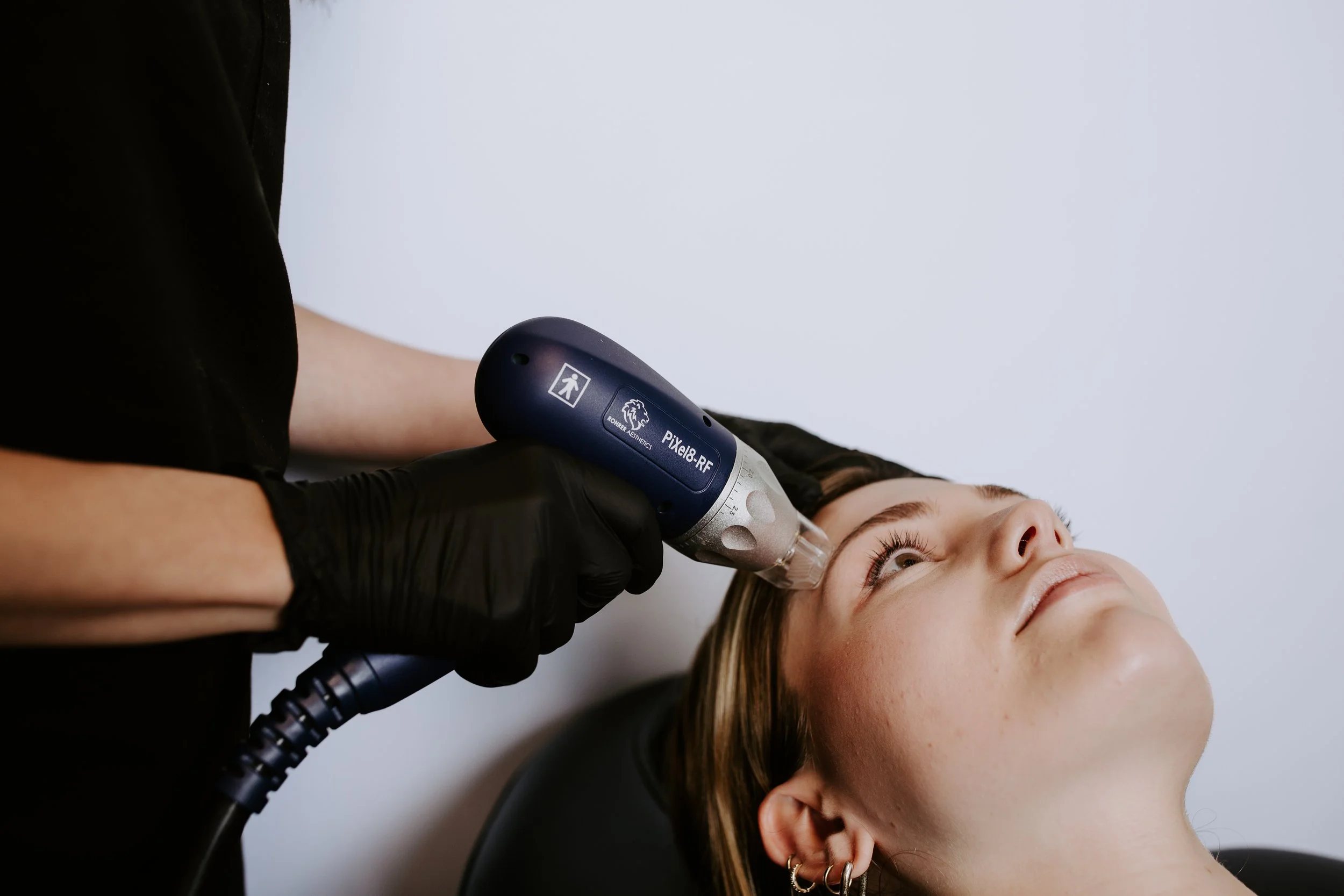 Gloved provider performing PiXel8-RF radiofrequency microneedling for sun damage and skin tone correction at Sona Medical Aesthetics Newcastle WA