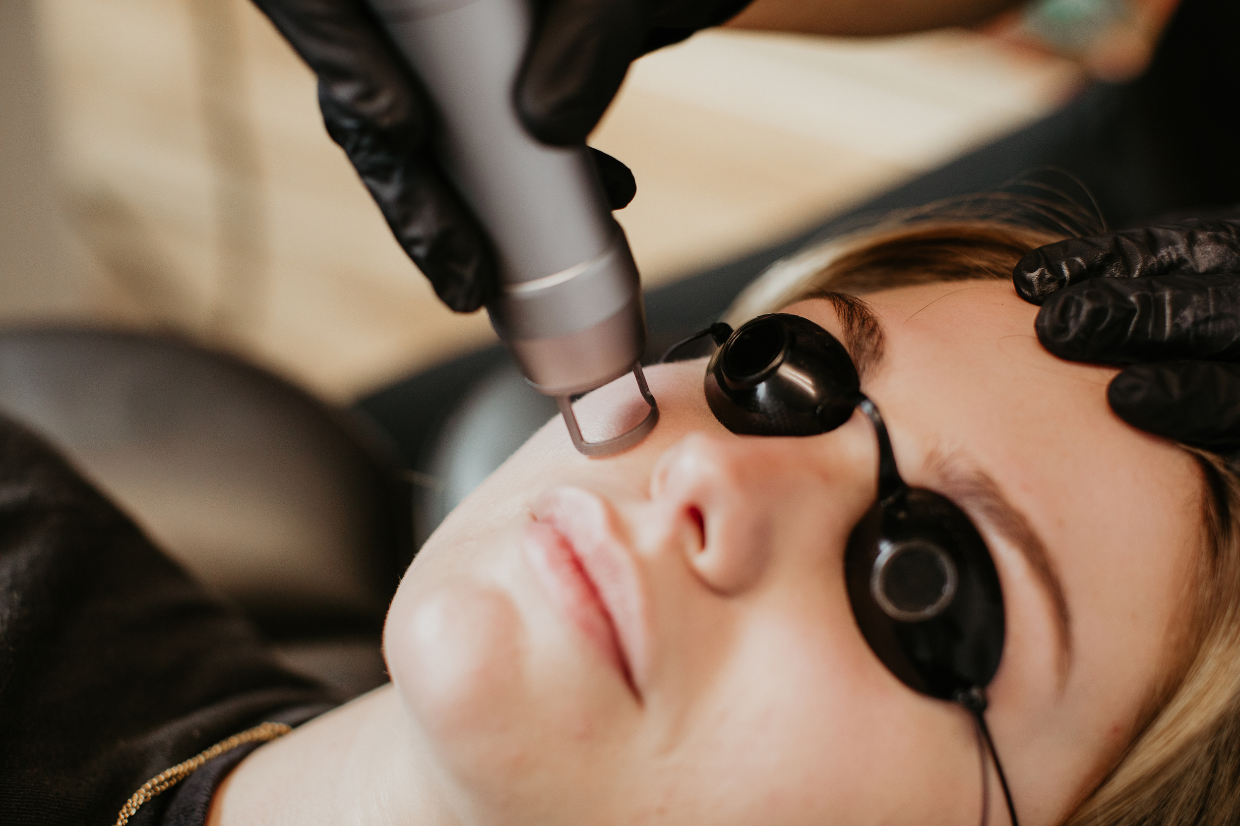 Gloved provider performing a facial laser treatment on a patient wearing protective eye shields at Sona Medical Aesthetics Newcastle WA