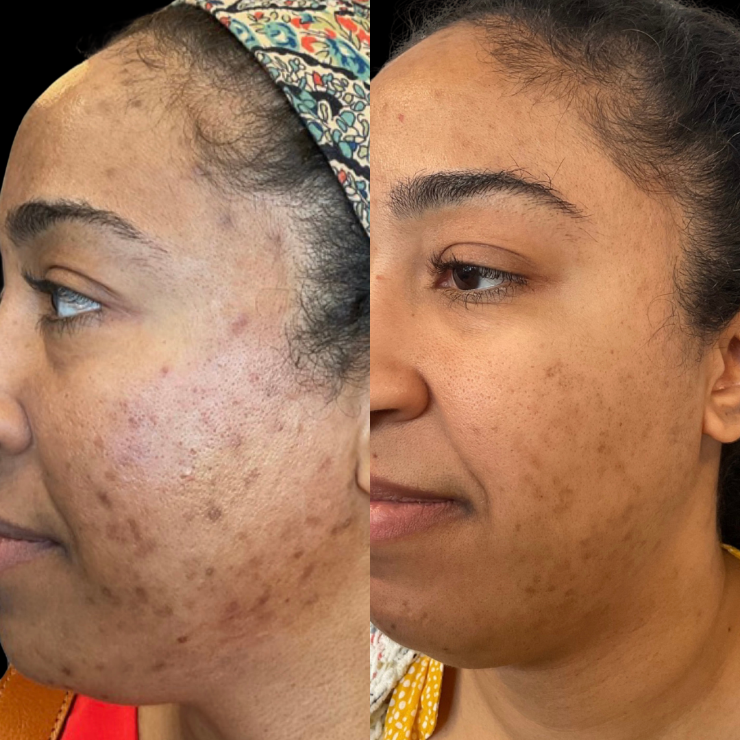 PICO LASER TREATMENT