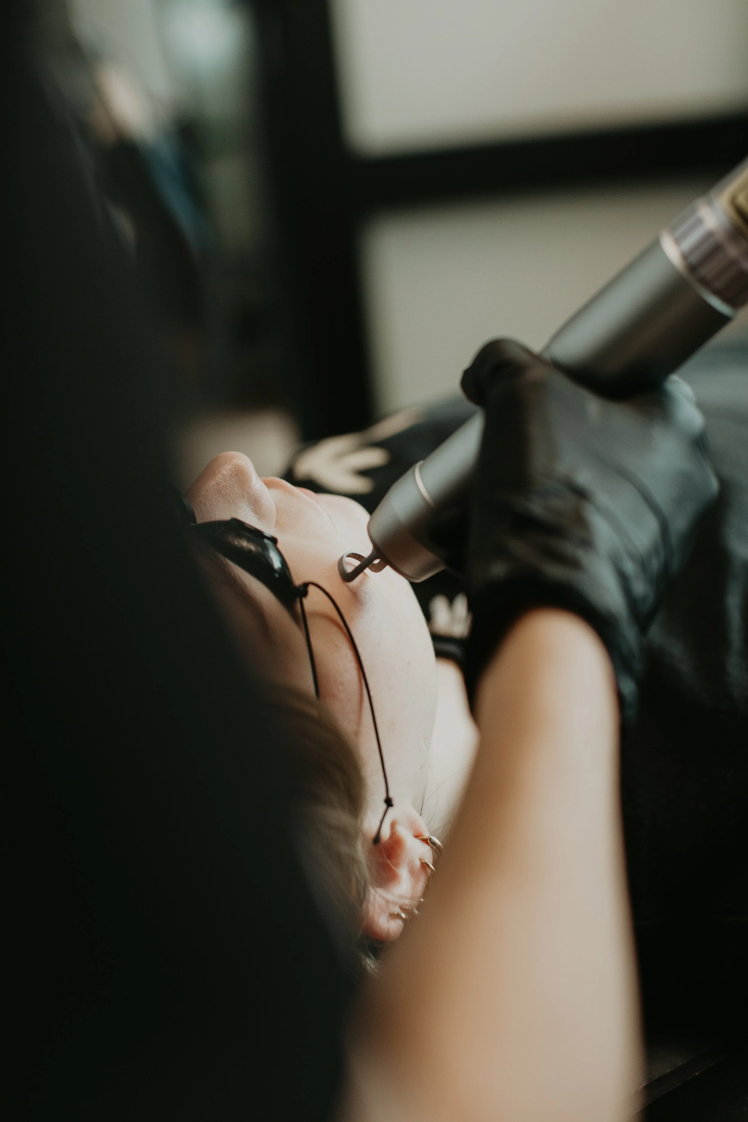 Provider performing Pico laser acne treatment on a patient at Sona Medical Aesthetics Newcastle WA