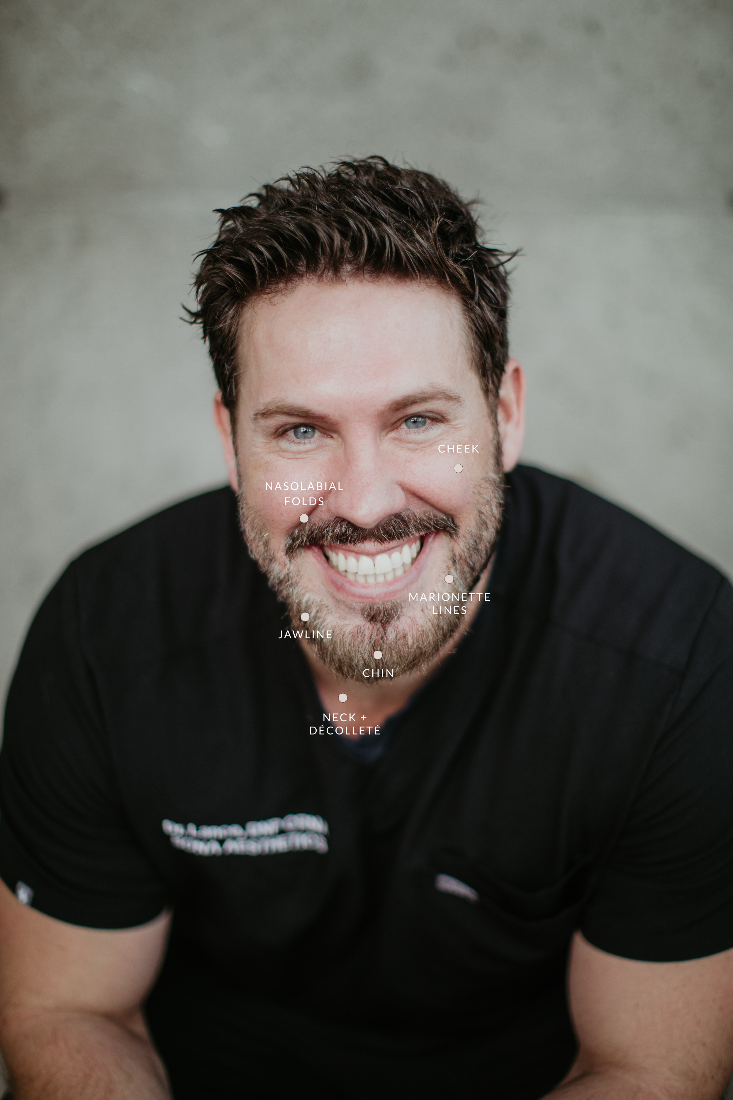 Radiesse collagen-stimulating injectable treatment areas at Sona Medical Aesthetics Newcastle WA