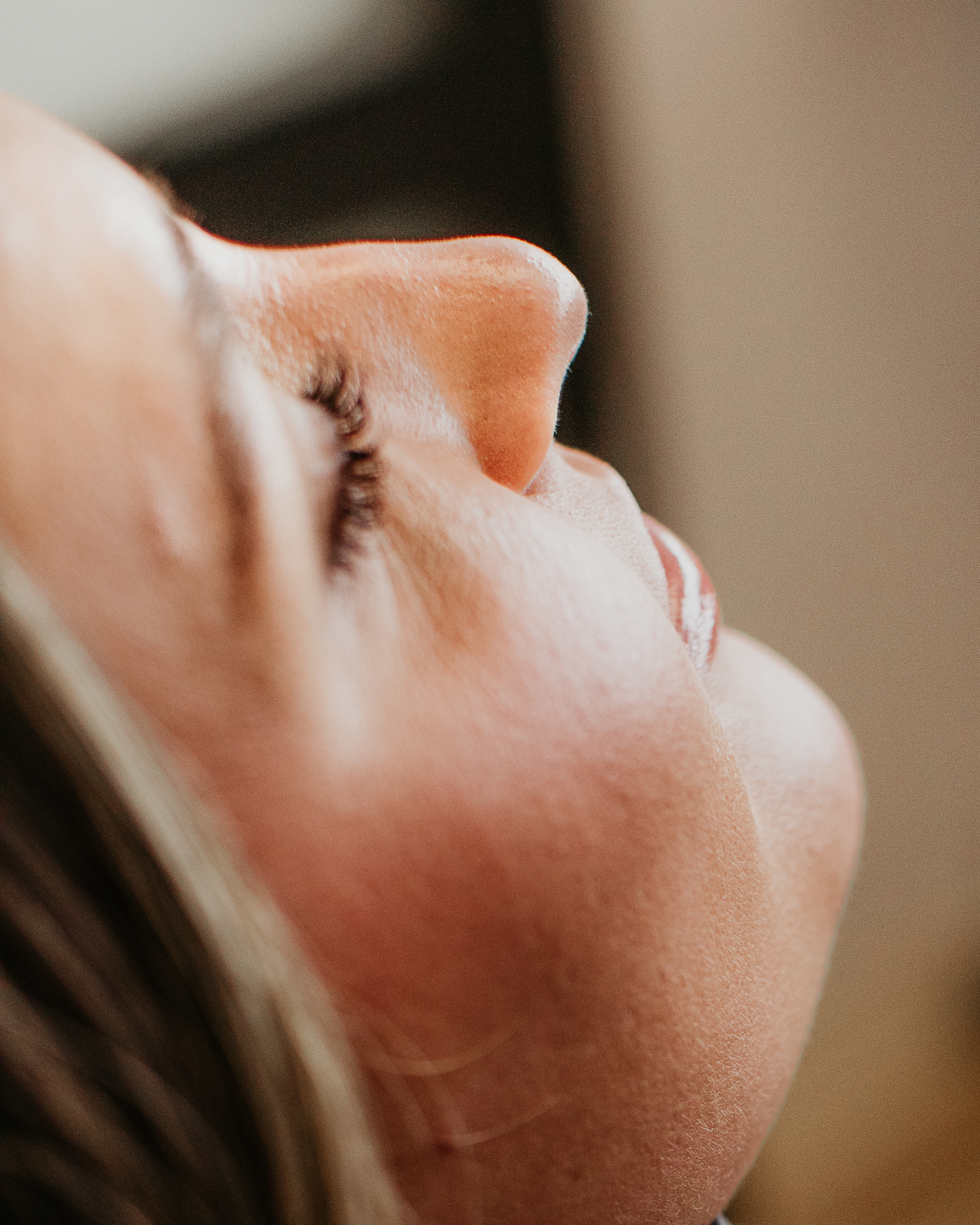 Close-up of a patient with topical numbing cream applied before a microneedling or microchanneling acne scar treatment at Sona Medical Aesthetics Newcastle WA