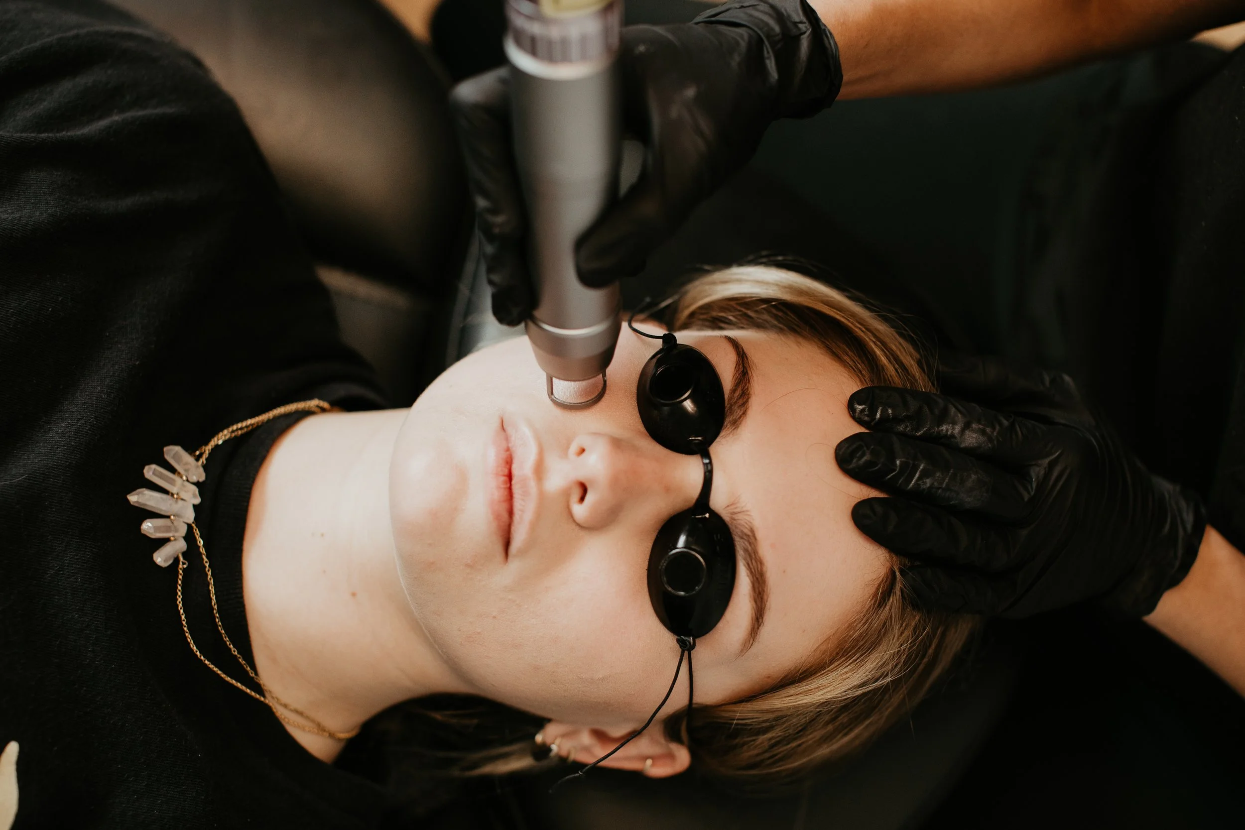 Gloved provider performing a laser pigment correction treatment on a patient wearing protective eye shields at Sona Medical Aesthetics Newcastle WA