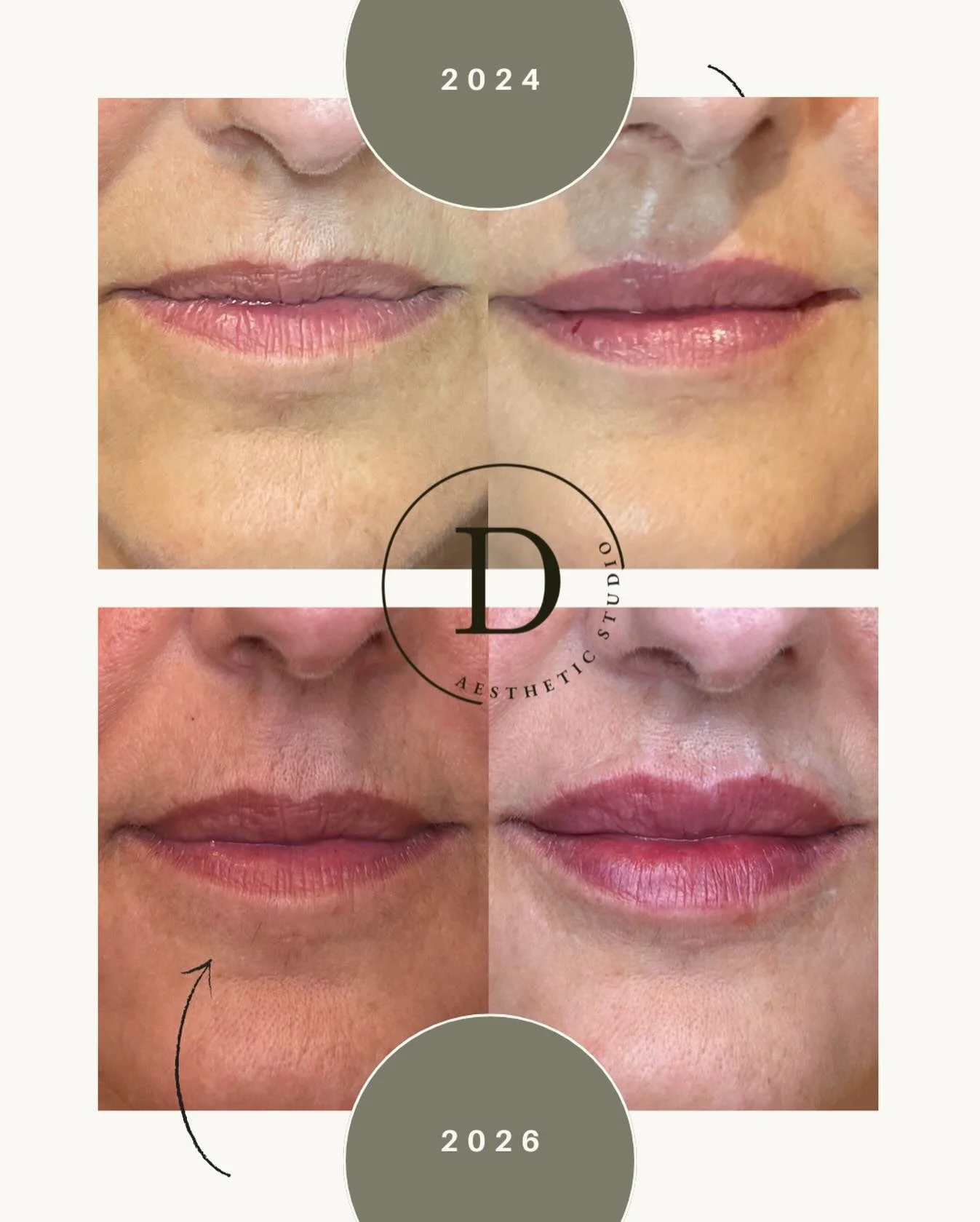 aJust here creating some magic. 2024-mini lip with Juvederm Volbella provided gorgeous lips and longevity, and 2026 mini lip with Revanesse Kiss, looking forward to healed results. 
International Woman&rsquo;s Day is approaching, You deserve it, and 