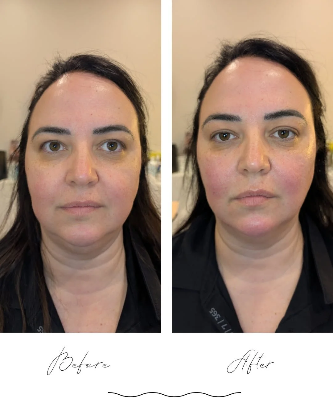 Injector self-care day
.
A little self-care and subtle refresh can help you feel more rested, confident, feminine, and like yourself again. Natural results, soft glow, and a reminder that taking care of yourself matters Thank you Margarita @thenarrac