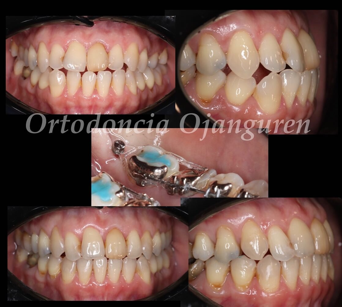 Ortodoncia lingual en casos de origen quir&uacute;rgico que no queremos operar. Realizamos un camuflado o compensaci&oacute;n lo m&aacute;s funcional posible. En ocasiones necesitamos de la ayuda de microtornillos 

.
#ortodoncista #ortodonciaojangur