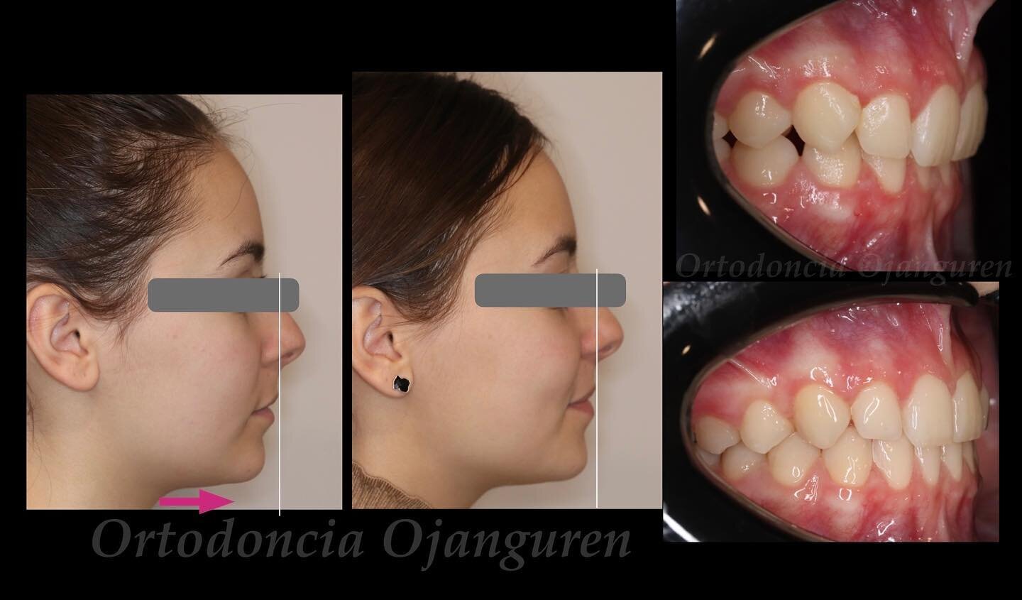 Expansion + Correcci&oacute;n sobremordida + Ligero Avance Mandibular con alineadores🫶🏼

.
.
#ortodonciaojanguren #claseii #ortodoncialogro&ntilde;o #invisalign #alineadores #teen #ortodonciainvisible #logro&ntilde;o