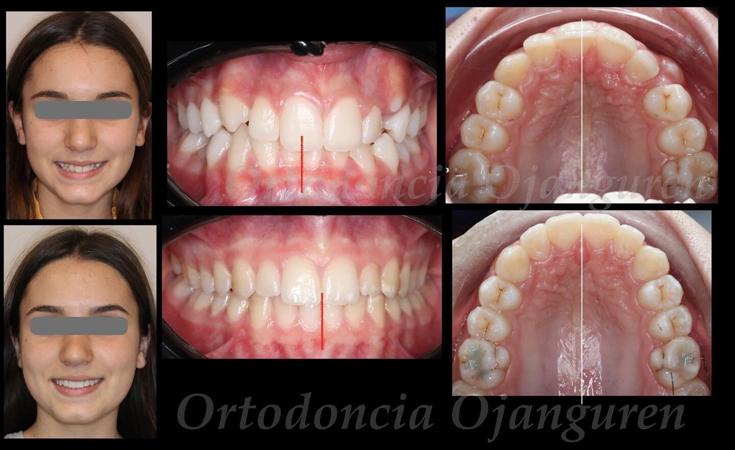 Desviaci&oacute;n por falta de espacio de erupci&oacute;n 🔆

.
.
#ortodonciaojanguren #ojanguren #ortodonciainvisible #ortodoncialogro&ntilde;o #braces #smile #alignment