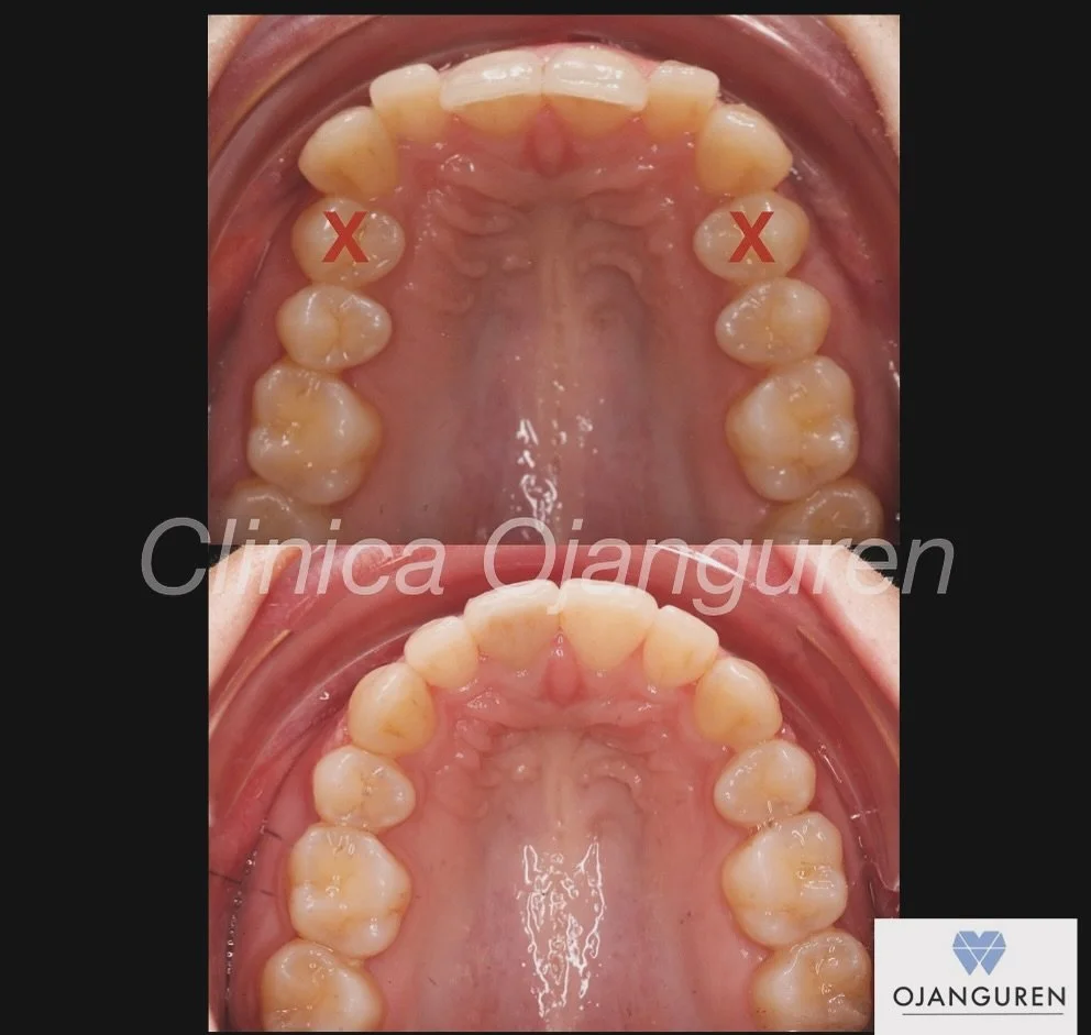 Correcci&oacute;n dentaria en clases II 🥰

&iquest;Sab&iacute;as que en ocasiones es necesaria la extracci&oacute;n de alg&uacute;n diente para poder compensar correctamente la mordida?
&iquest;Te han dicho que necesitas extracciones en tu caso, per