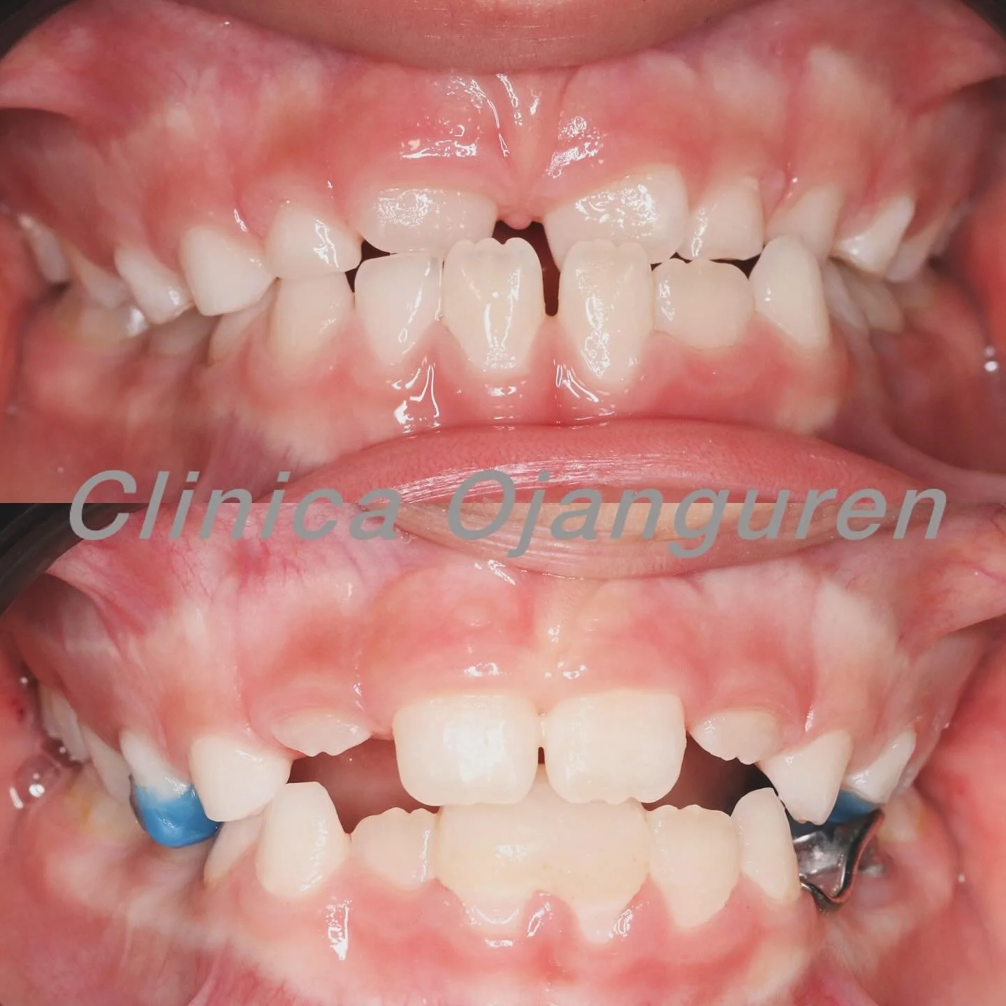 🎈Con cada pista de RNO ayudamos a que los ni&ntilde;os crezcan con armon&iacute;a, en equilibrio 🌱

☎️ 946 52 58 10
📍Elcano, 28 Bajo Bilbao

.
#rno #rmr #clinicaojanguren #ortodonciaojanguren #ortodonciabilbao #ortopedia #pistas #planas #equilibri