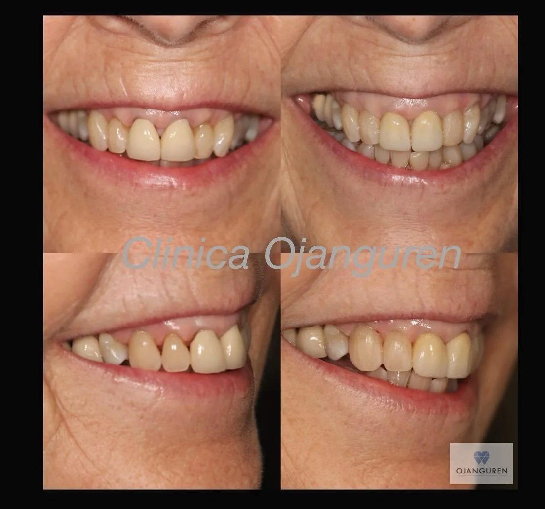 🔹Peque&ntilde;as modificaciones en pacientes +70🔹
〰️ Cambio de coronas
〰️ Cierre de troneras

.
#veneers #Ojanguren #clinicaojanguren #dentistabilbao #crown #aesthetic