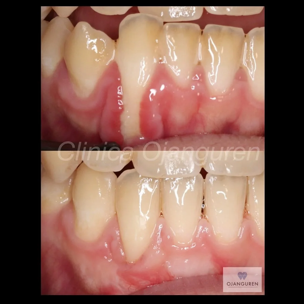 🔆Colgajo desplazado lateral + injerto de tejido conectivo🔆

💚Recesi&oacute;n profunda 
💚Ortodoncia previa para desplazar la ra&iacute;z dentro de hueso

La recesi&oacute;n gingival es muy frecuente en los pacientes. Hasta un 84% de la poblaci&oac