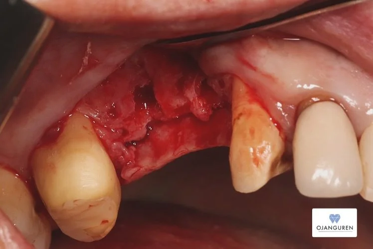 Rehabilitaci&oacute;n con implantes y regeneraci&oacute;n horizontal.
 
🔹Fresado, perforaciones y recolecci&oacute;n de hueso del paciente.
🔹 Regeneraci&oacute;n con hueso aut&oacute;logo + xenoinjerto.
🔹 Membrana para contenci&oacute;n y cierre f