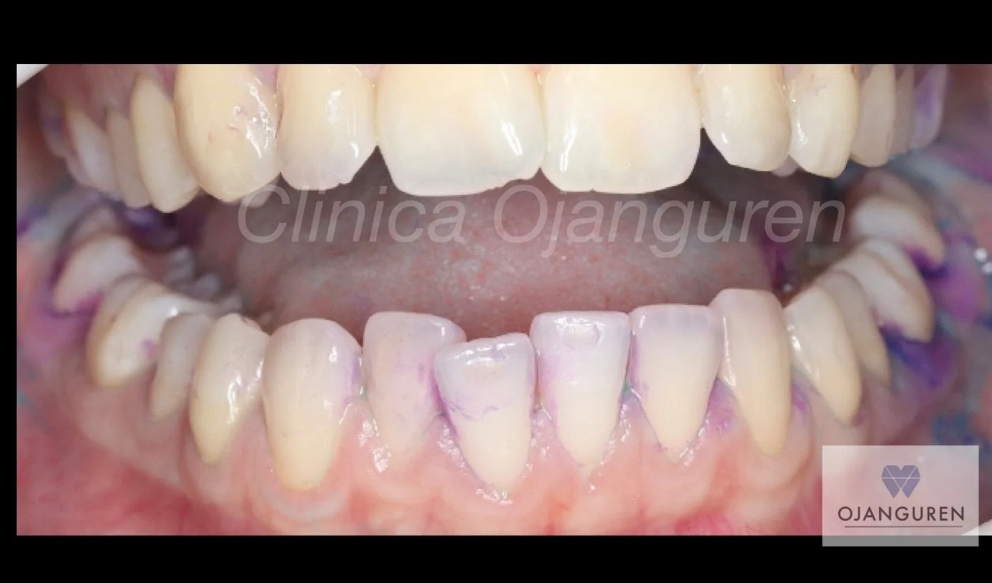 Hoy en consulta usamos GC Tri Plaque ID Gel (revelador de placa tricolor) para que la higiene deje de ser &ldquo;a ojo&rdquo; y pase a ser visible 👀🦷

🔎 &iquest;Qu&eacute; significa cada color?
🩷 Rosa/Rojo: placa reciente (acumulaci&oacute;n nuev