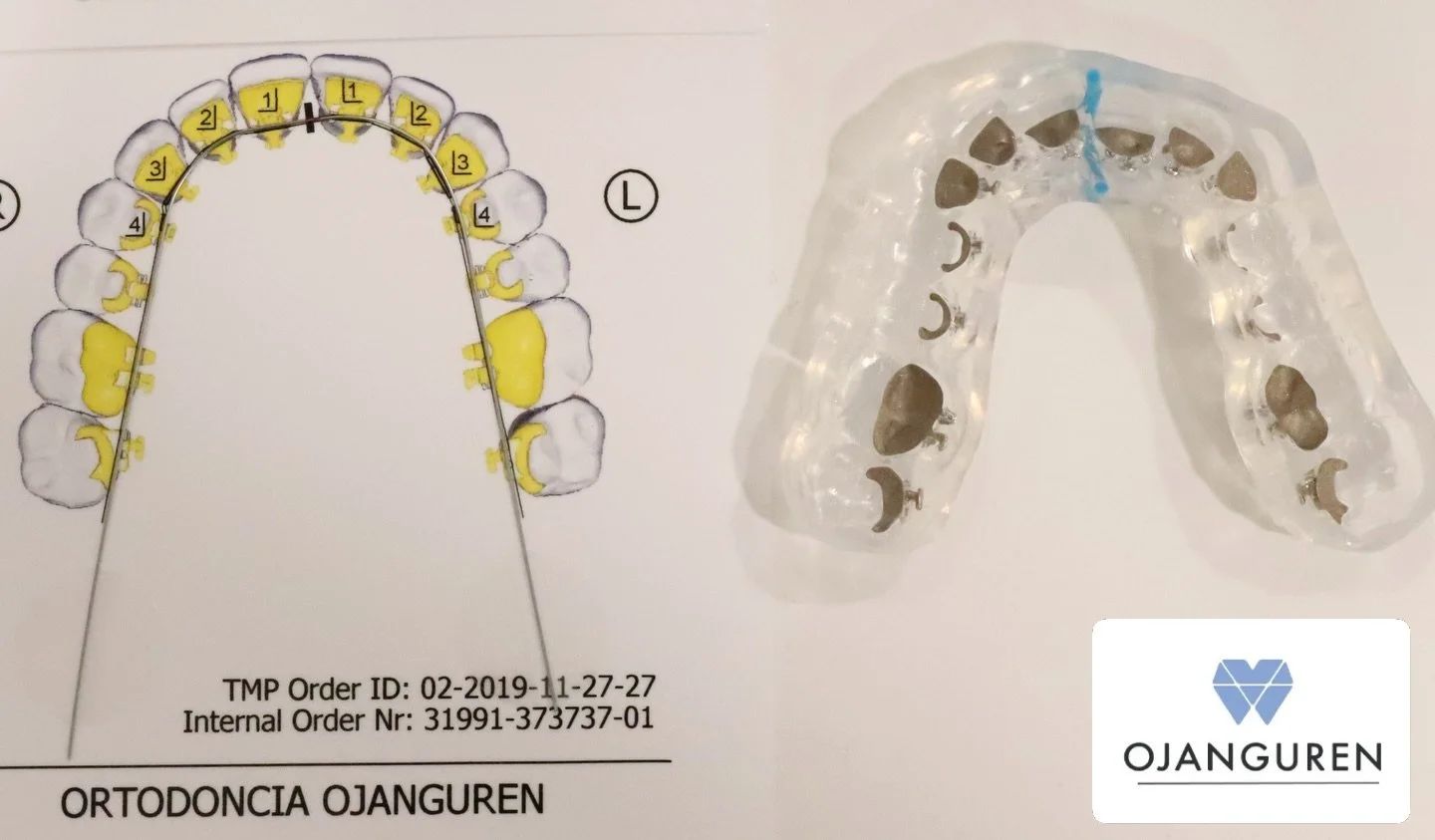 &iquest;Sab&iacute;as que la ortodoncia lingual se coloca con una t&eacute;cnica llamada cementado indirecto?

✅ Mayor ajuste y precisi&oacute;n
✅ Mayor rapidez
✅ Menos molestias para el paciente

#clinicaojanguren #dentistabilbao #ortodoncialingual
