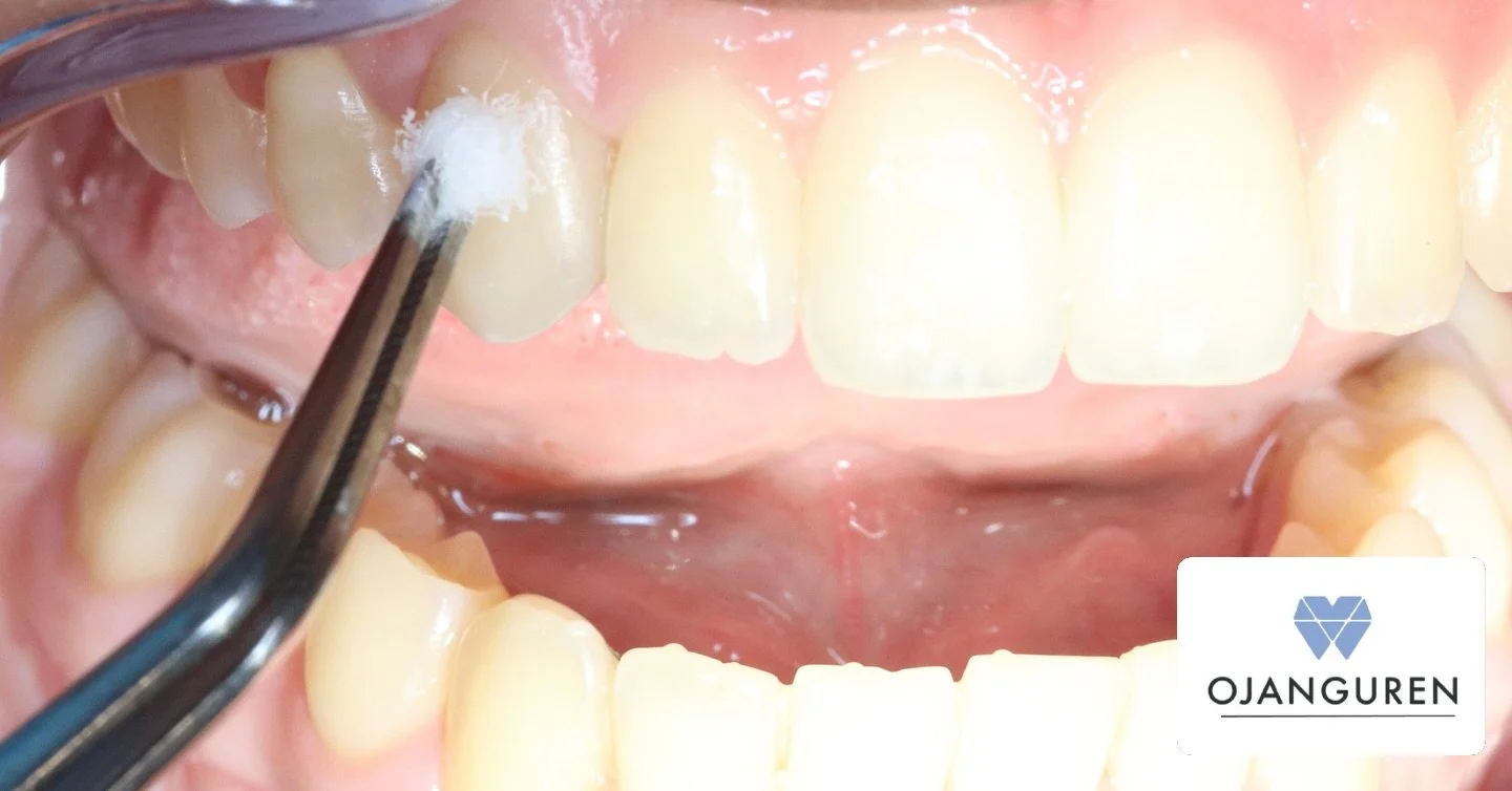 Las pruebas de vitalidad valora si la pulpa dental responde a un est&iacute;mulo. &iquest; Qu&eacute; busca ?

➖ Normalidad
➖ Inflamado pero reversible
➖ Inflamado irreversible
➖ Necrosis

📍Elcano, 28 Bilbao
☎️ 946 52 58 10