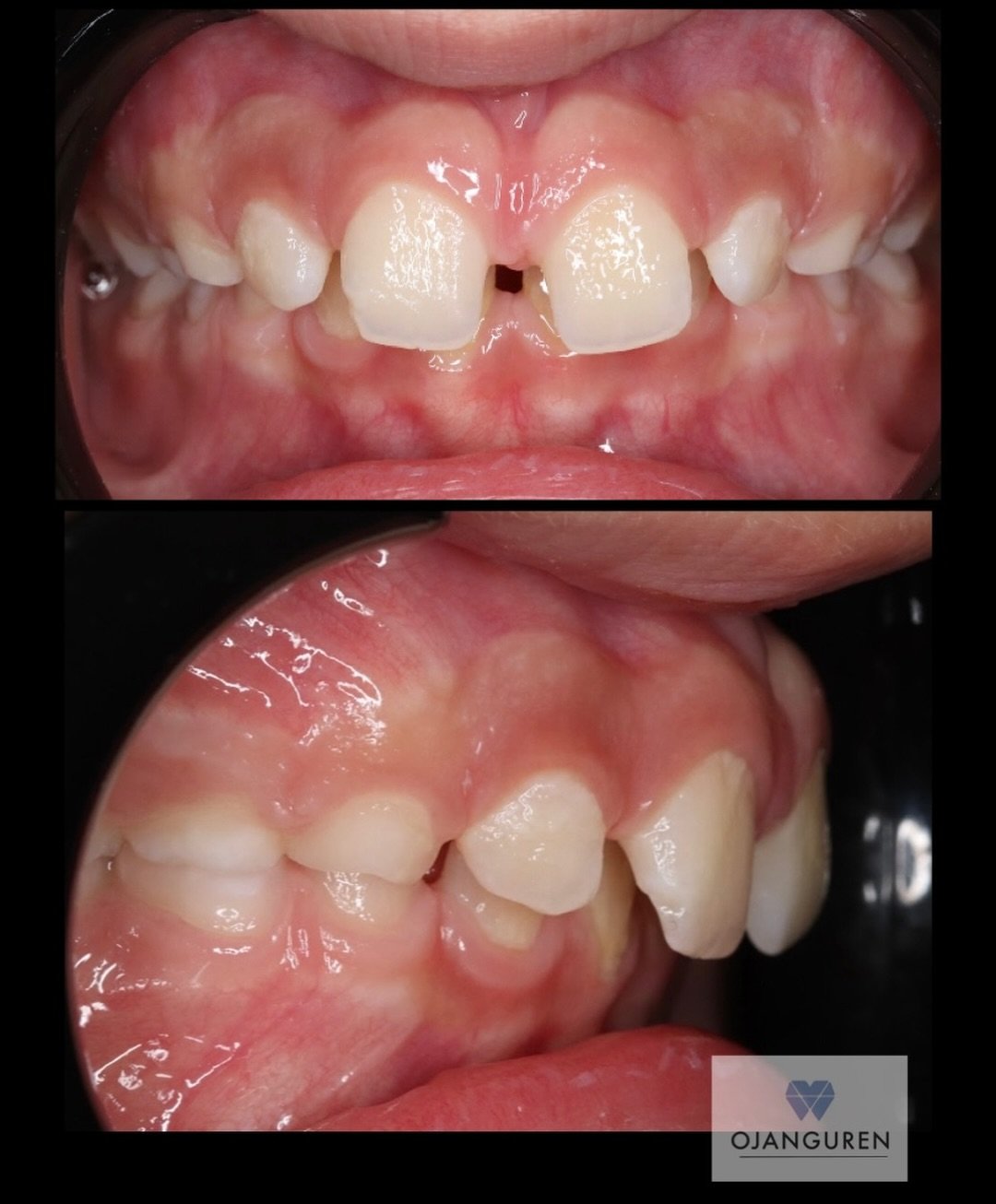 &iquest;Cu&aacute;ndo deber ver el ortodoncista a un ni&ntilde;o?
🗣️ Pues aunque pueda sonar exagerado, desde que erupcionen los primeros dientes 

📍Elcano 28
☎️ 946 525 810