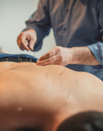 Acupuncture for Back Pain: The Natural Relief You’re Looking For