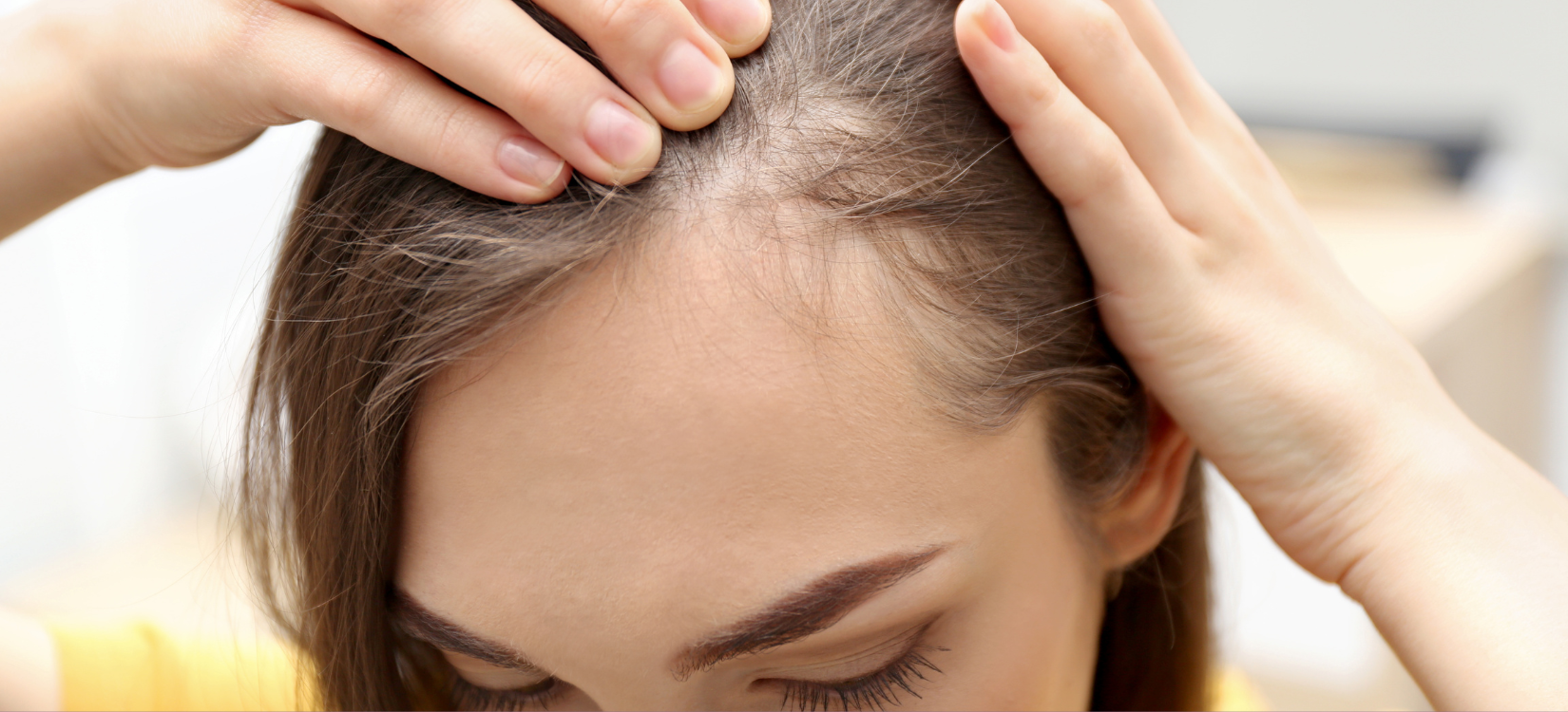 Hair Loss on GLP-1 Medications