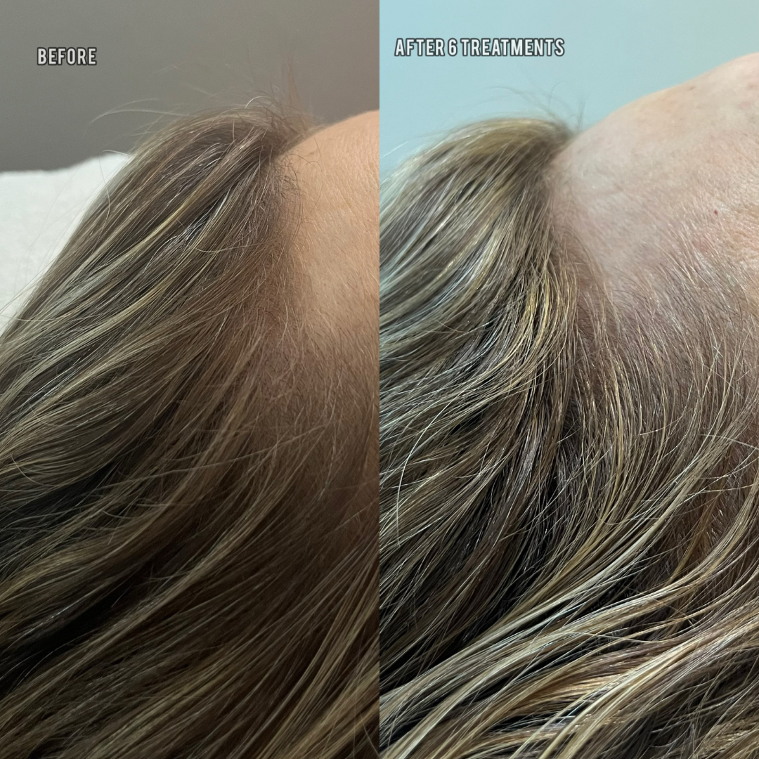 Hair Loss & Thinning Hair Treatments in Arvada, CO | Calm Spirit — Calm ...