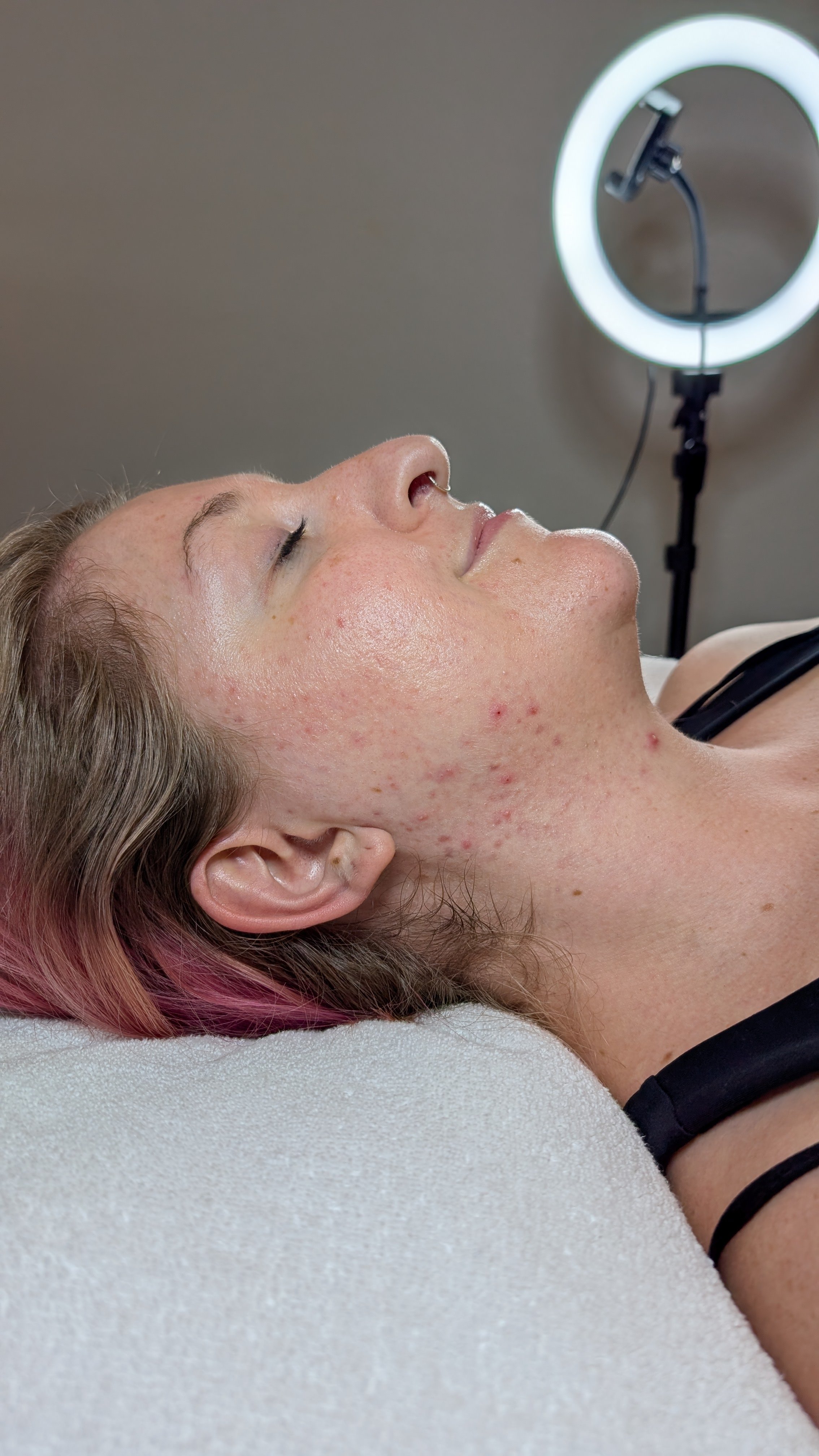 A woman lying down during a skincare or dermatological treatment, with a ring light in the background illuminating her face.