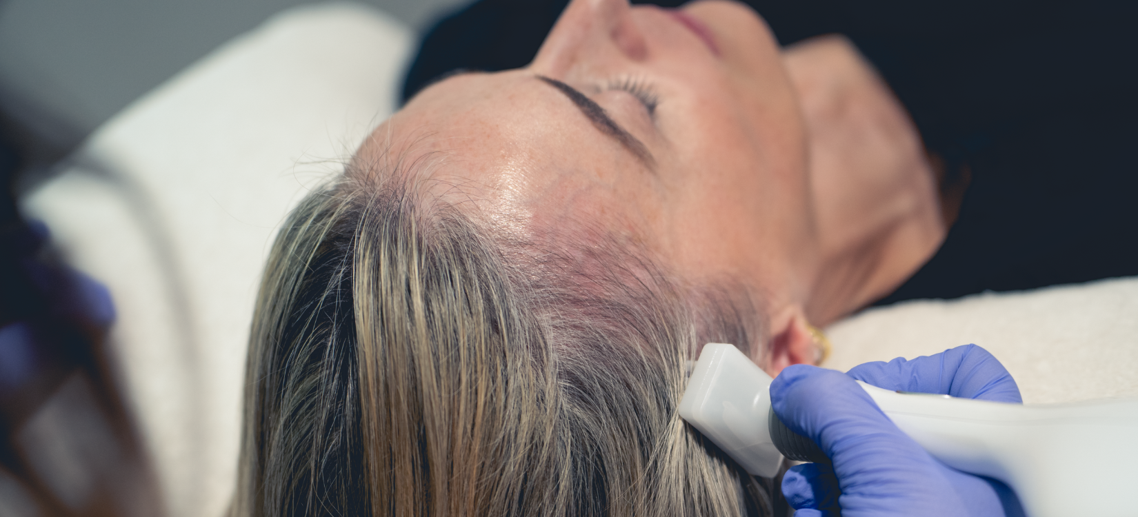 a woman is receiving root cold plasma for hair growth