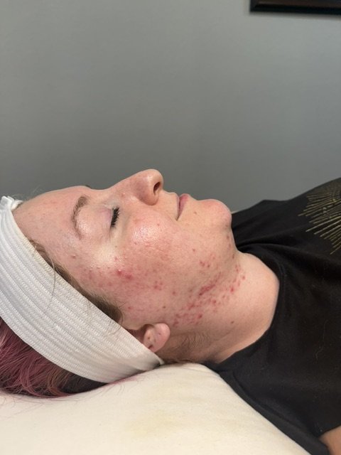 Side view of a woman with acne on her face lying on a bed with a white headband.