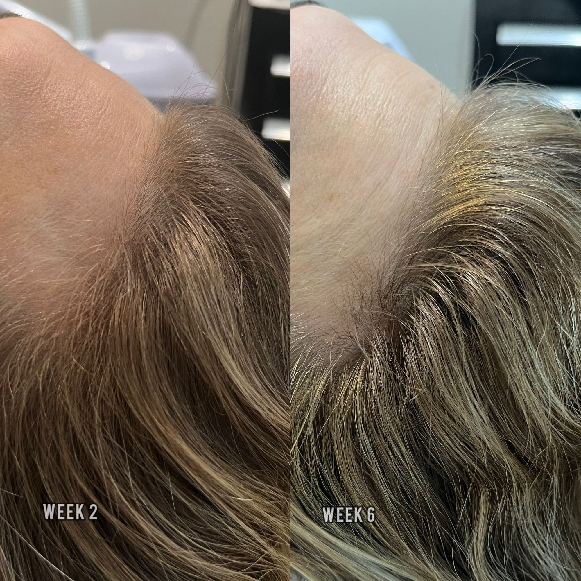 Hair Loss & Thinning Hair Treatments in Arvada, CO | Calm Spirit — Calm ...