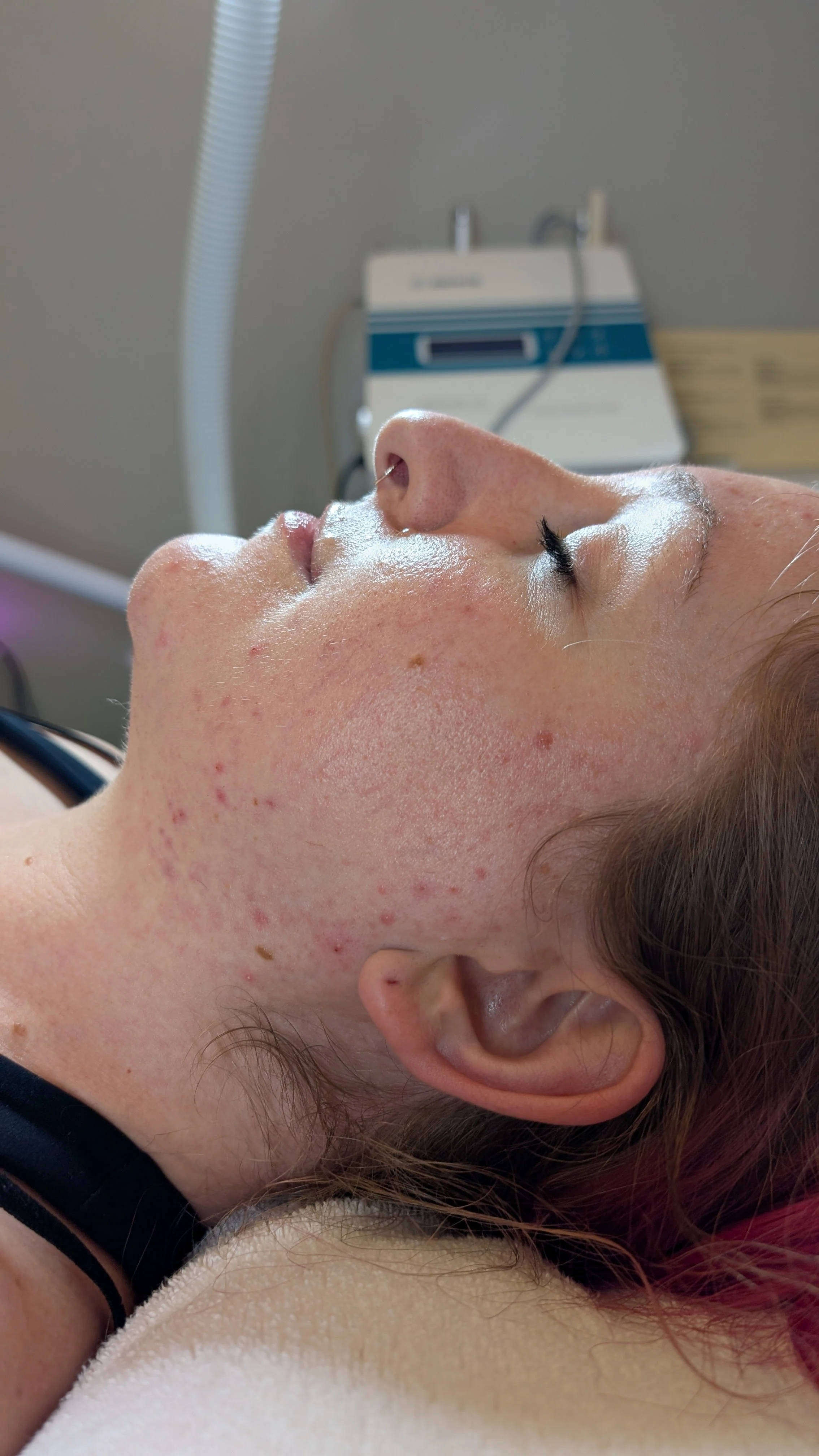 A person lying down with closed eyes and acne on their face in a medical or skincare setting.