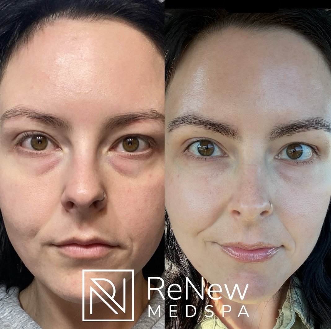 ✨ Let&rsquo;s Talk PRP: 24-Hour Under Eye Results

This before and after was taken just 24 hours apart following an Under Eye PRP treatment&mdash;showcasing how quickly your skin can begin to respond to natural healing.

PRP (Platelet-Rich Plasma) wo