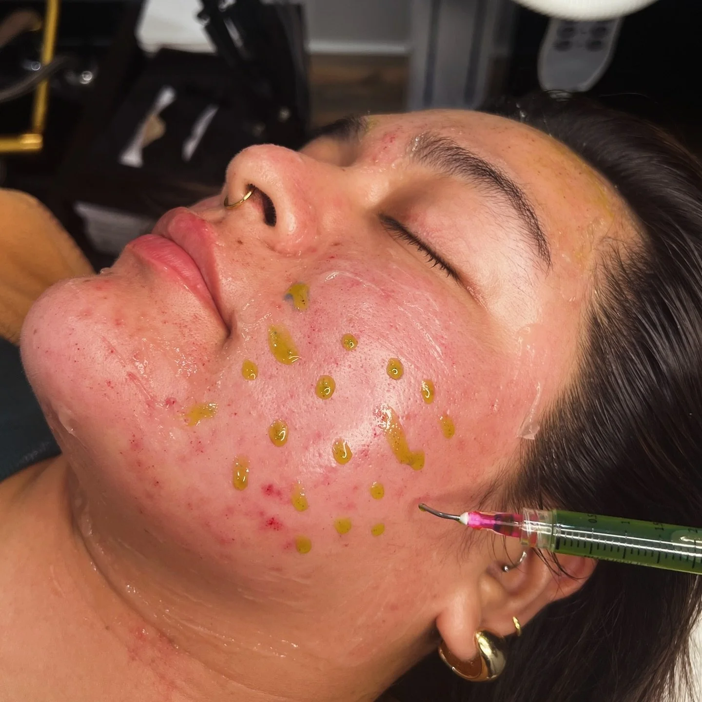 ✨ Transforming acne scars into smooth, radiant skin ✨

This patient is receiving SkinPen&reg; Microneedling paired with our BioRePeel for advanced acne scar revision. The SkinPen creates precise micro-injuries to stimulate collagen and skin renewal, 
