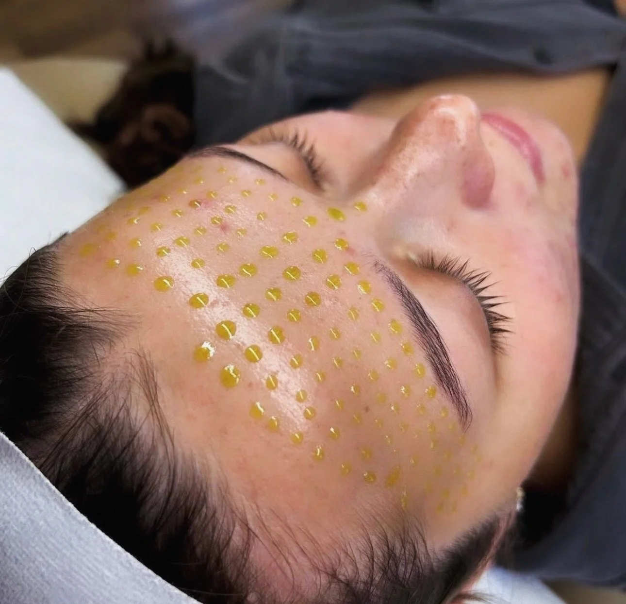 Our BioRePeel &amp; Dermaplaning Treatment is perfect for improving pigmentation, acne, texture, and overall complexion&mdash;just in time for summer. This treatment boosts cell turnover, brightens the skin, and smooths texture with no downtime, just