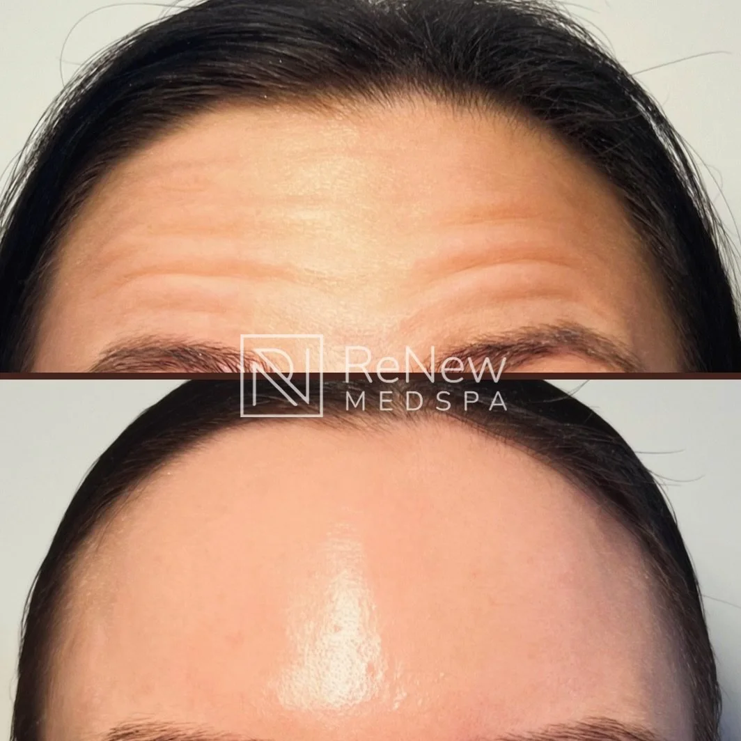 Before &rarr; After: Frontalis &amp; Glabella with Daxxify

A smoother forehead&hellip; and that glow. ✨

In this treatment, we focused on relaxing the forehead lines and glabellar &ldquo;11s&rdquo; using Daxxify. By softening the muscles that create