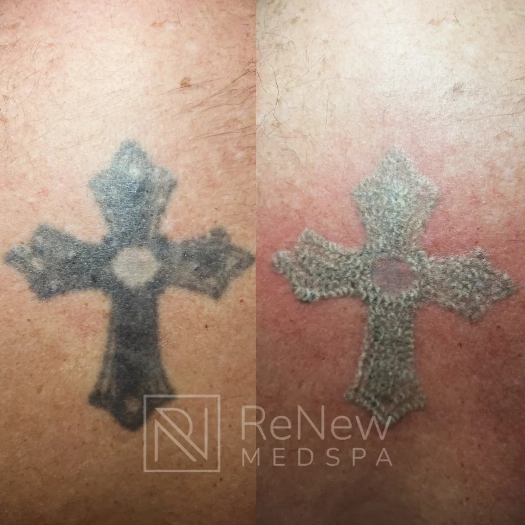 One session. Real results.

This is a before and after after just ONE session of laser tattoo removal using our advanced PICO laser technology. The pigment has already begun to break apart, allowing your body to naturally eliminate the ink over time.
