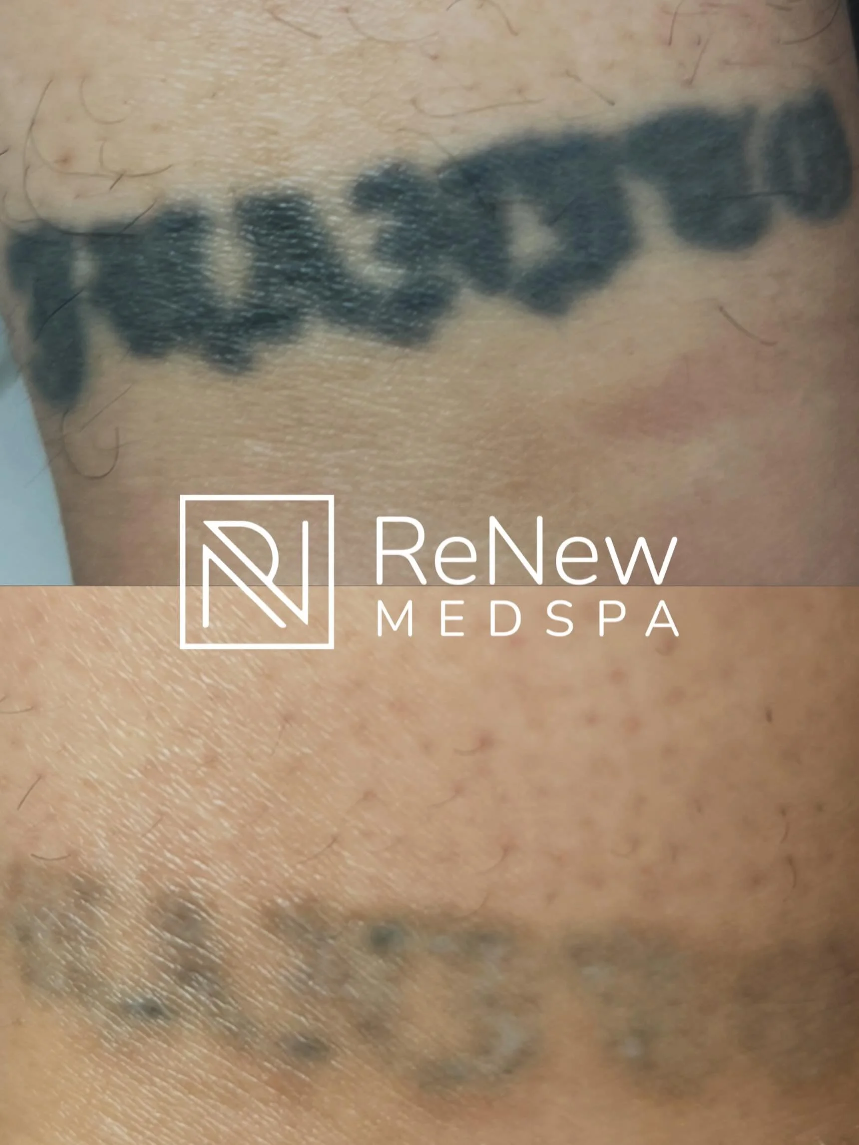 We&rsquo;re almost there&hellip; 👏 One more treatment and this tattoo will be nearly impossible to see. Watching tattoo removal progress like this is one of the most satisfying parts of what we do because every session gets you closer to a clean sla