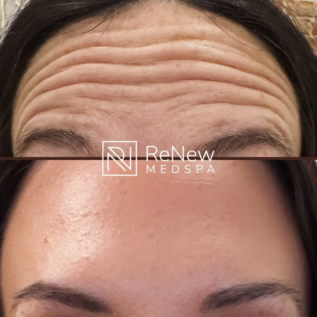 The Power of Daxxify ✨

This before &amp; after forehead transformation is exactly why we love Daxxify at ReNew MedSpa. Not only does it beautifully soften lines while keeping results natural and refreshed, but its unique peptide-powered formula is w