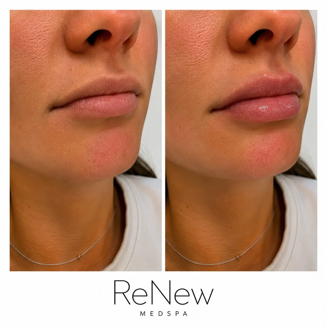 ✨ The lips. The balance. The confidence. ✨

Beautiful filler should NEVER look obvious. The best results enhance your natural features, restore lost volume, improve proportions, and create harmony throughout the face&mdash;all while still looking lik