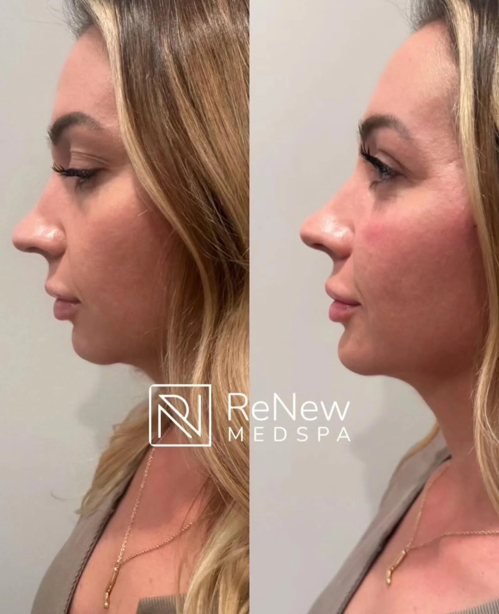 Facial balancing is about more than adding volume &mdash; it&rsquo;s about creating harmony, proportion, and natural-looking results that enhance the features you already have.

These results were achieved through a customized facial balancing treatm