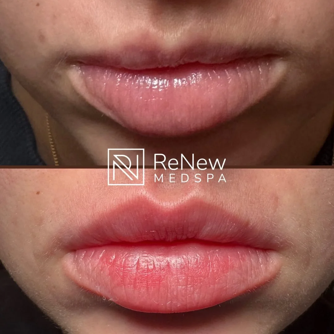 A little balance can make a big difference.

This beautiful lip enhancement focused on restoring volume to the upper lip, defining the cupid&rsquo;s bow, and creating better harmony between the upper and lower lip. The result is a naturally balanced,