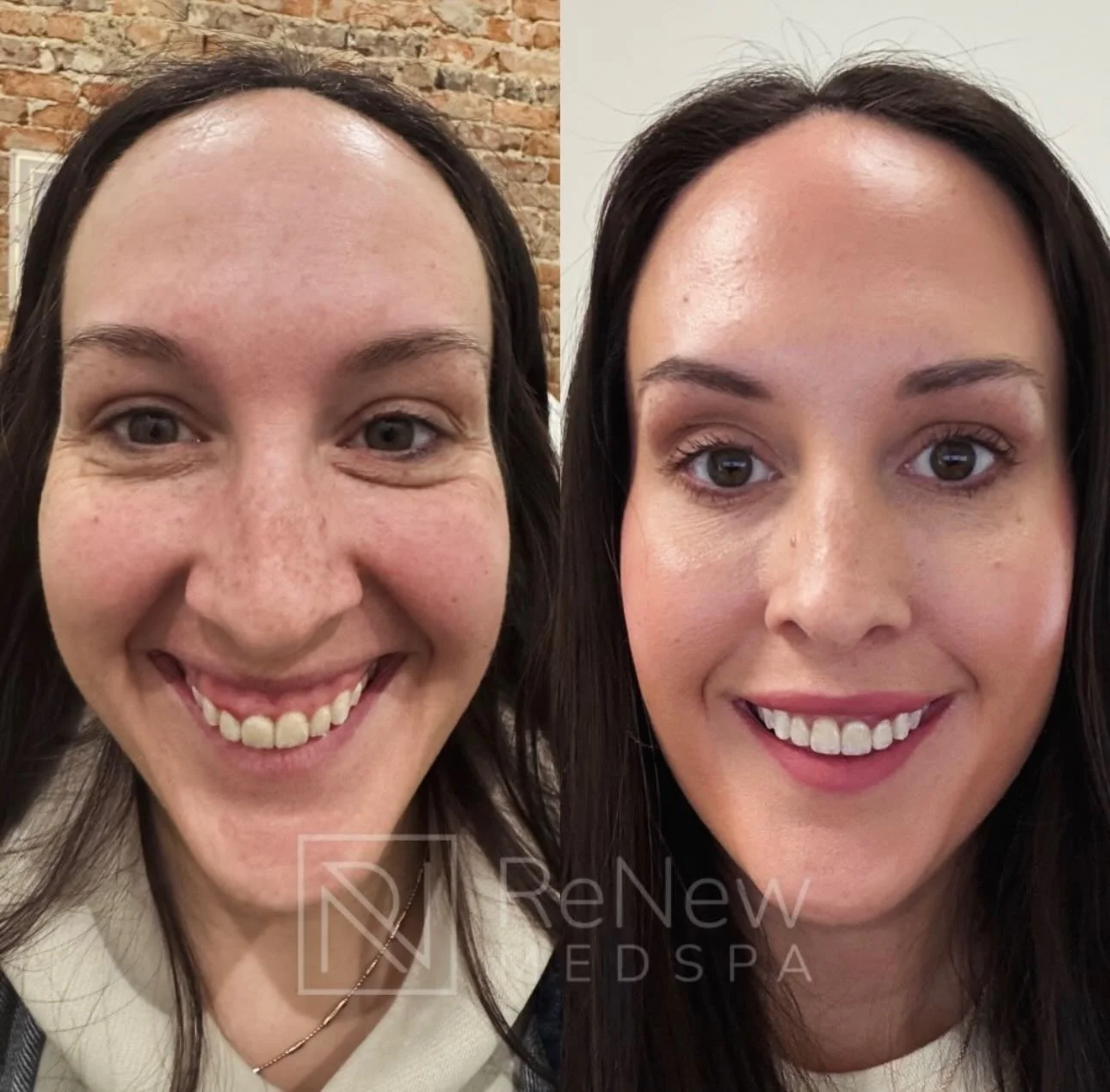 3 Days Left.

If you&rsquo;ve been thinking about doing something for yourself, refreshing your look, restoring lost volume, or finally addressing a concern you&rsquo;ve been putting off&mdash;now is the time to reach out.

We know filler can come wi