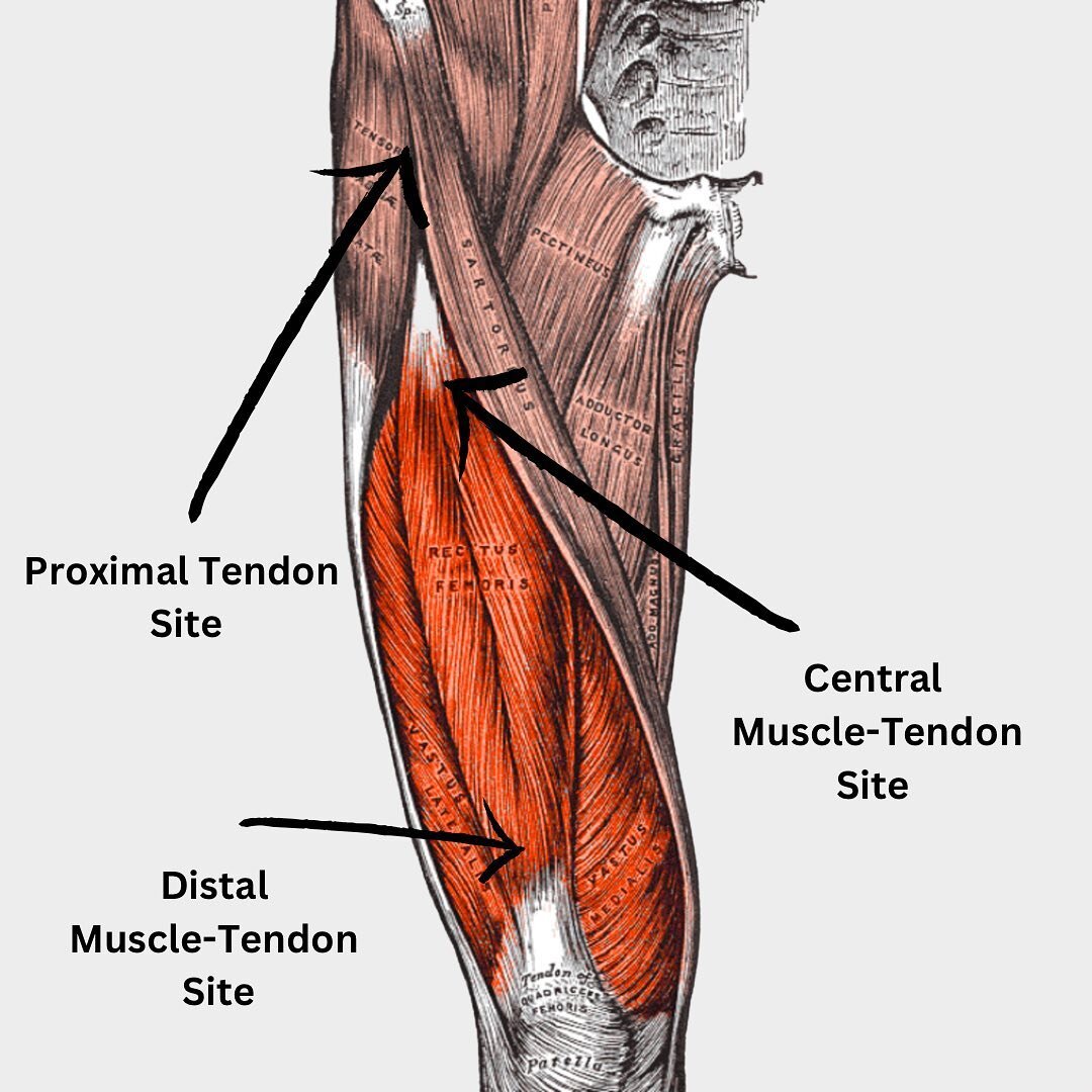 Almost all Quadricep muscle strains affect the Rectus Femoris muscle and tend to occur at 3 main sites. 

The unique anatomy and function of the quad muscle ls means that these injuries can be complex and require and in-depth assessment.

For more se
