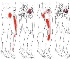 Piriformis Syndrome - a nagging pain in the butt