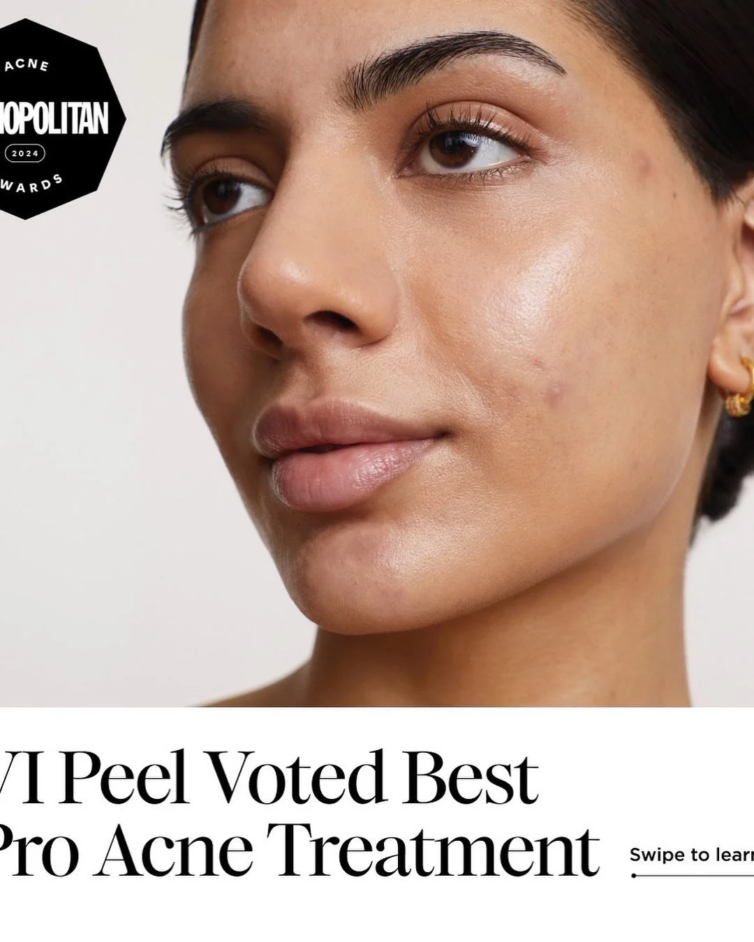 #vipeel #acnetreatment #beautifulskin