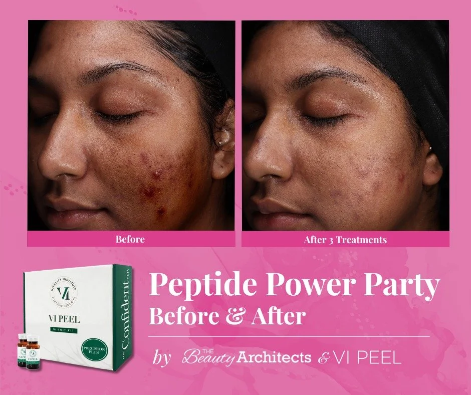 ✨ One VI Peel&reg; feels amazing&hellip; but three? That&rsquo;s where the real magic happens. Check out this glow-up!

Ready to see the future of pigment correction? The VI Peel Precision + Peptides is here to transform your skin. 

💬 DM us to lear