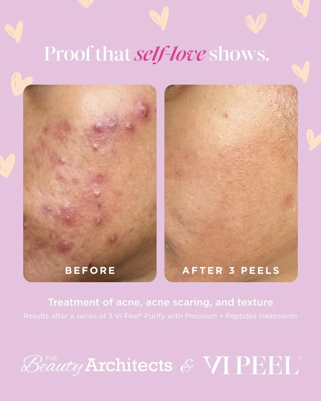 Fall in love with your skin again. A @vipeel is the perfect match for smoother, clearer, brighter skin. DM us if you would like a referral to one of our premium providers in your area!

#VIPeel #valentinesday #TheBeautyArchitects #SkinVitality #Glowi