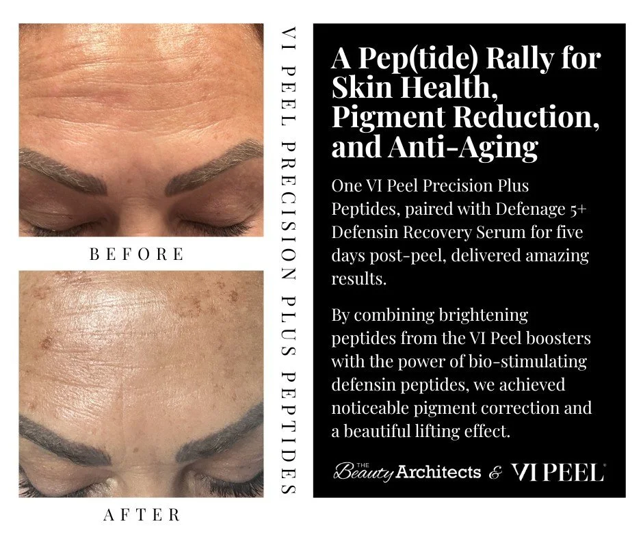A Pep(tide) Rally for Skin Health, Pigment Reduction, and Anti-Aging 📣 ✨ 

One @vipeel Precision Plus with peptides, paired with @defenagepro 5+ Defensin Recovery Serum for five days post-peel, delivered amazing results. By combining brightening pep