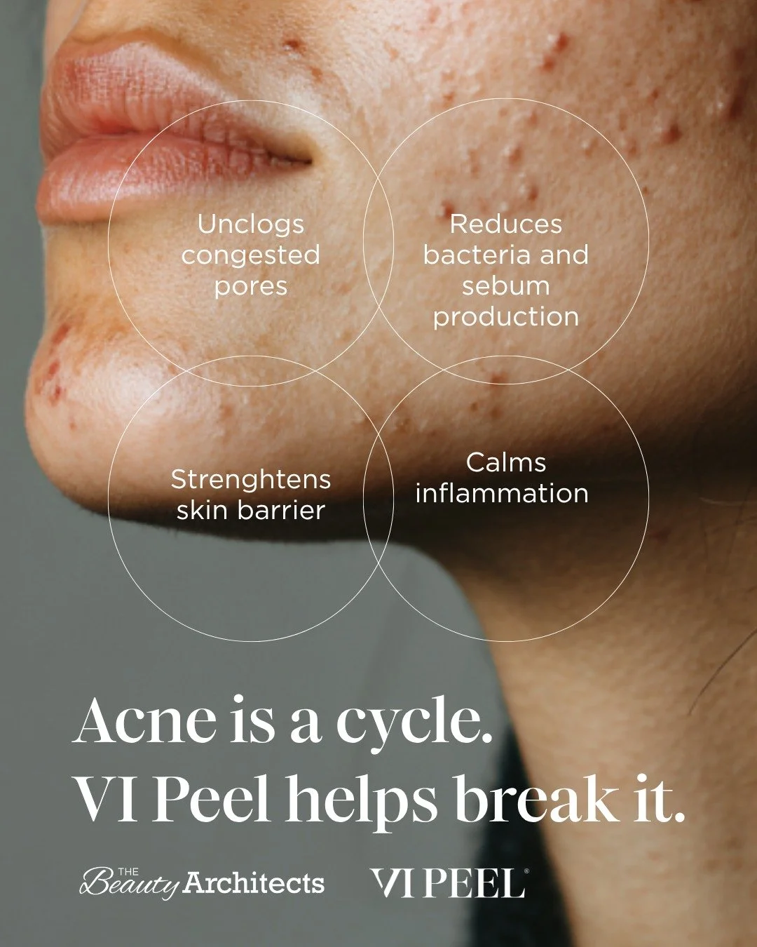 Acne is a cycle. VI Peel helps break it. ✨

Book your series of 3 today and begin your skin confidence journey. DM us to find a premier provider near you!

#VIPeel #VIDerm #SkinHealth #GlowingSkin #Acneawarenessmonth