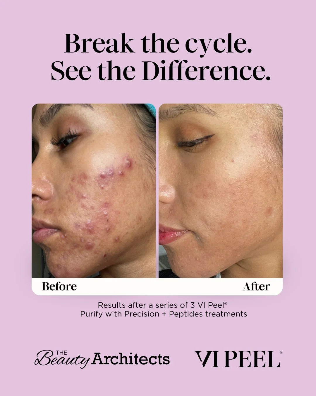 Acne is stubborn. VI Peel can help.

Book your series of 3 today and begin your skin confidence journey. DM us to find a premier provider near you!✨

#VIPeel #VIDerm #SkinHealth #GlowingSkin #Acneawarenessmonth
