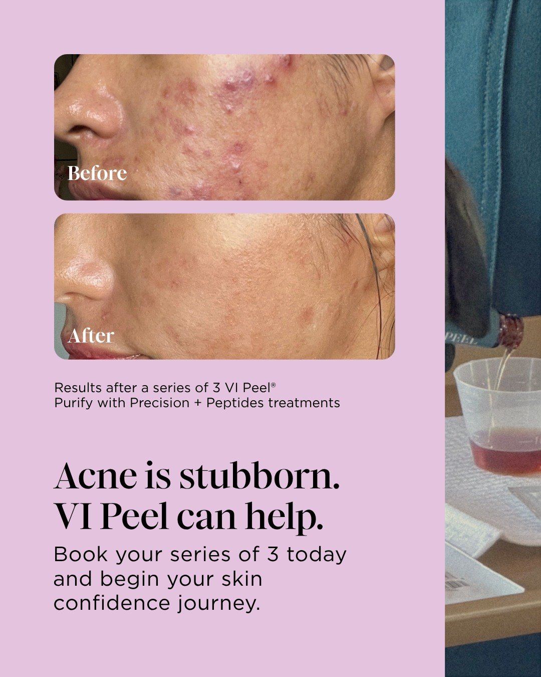Break the cycle. See the difference. 

Book your series of 3 today and begin your skin confidence journey. DM us to find a premier provider near you! ✨

#VIPeel #VIDerm #SkinHealth #GlowingSkin #Acneawarenessmonth