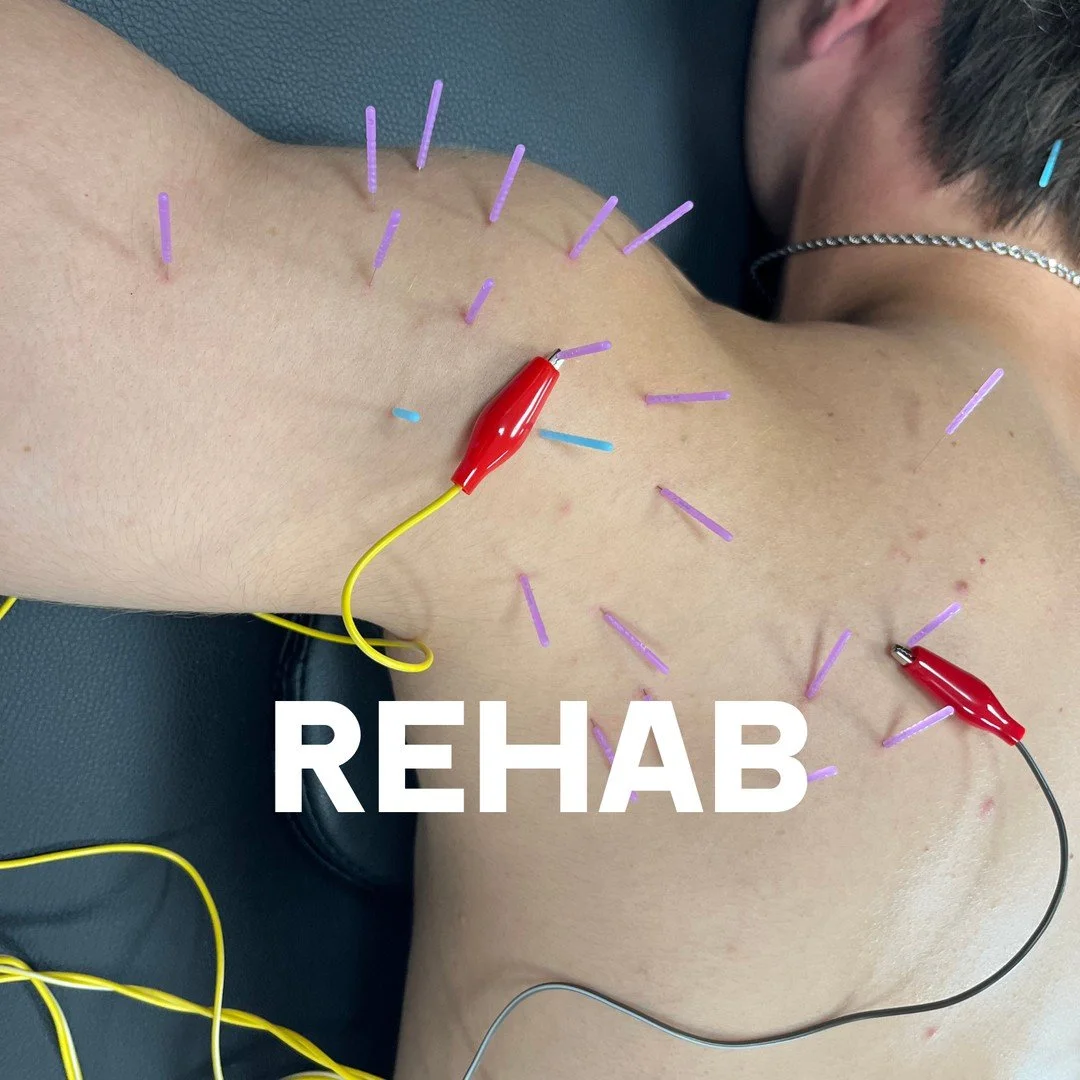 REHAB: close view of a patient's shoulder and upper back with dry needling needles in place and two electrical stimulation leads attached